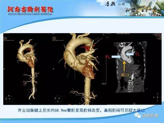 【PPT】胸痛相关疾病的影像诊断