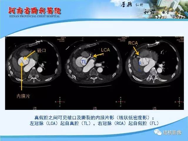 【PPT】胸痛相关疾病的影像诊断