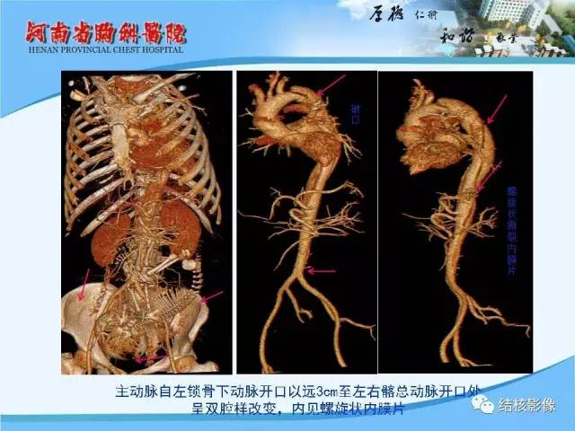 【PPT】胸痛相关疾病的影像诊断