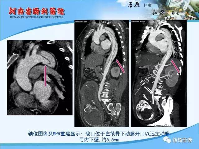 【PPT】胸痛相关疾病的影像诊断