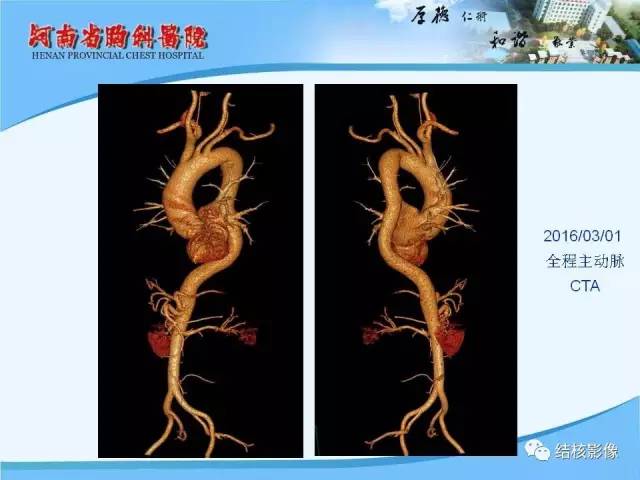 【PPT】胸痛相关疾病的影像诊断