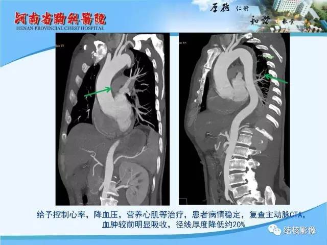 【PPT】胸痛相关疾病的影像诊断