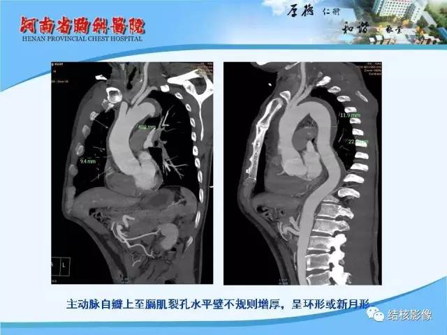 【PPT】胸痛相关疾病的影像诊断
