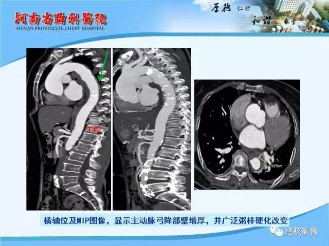 【PPT】胸痛相关疾病的影像诊断