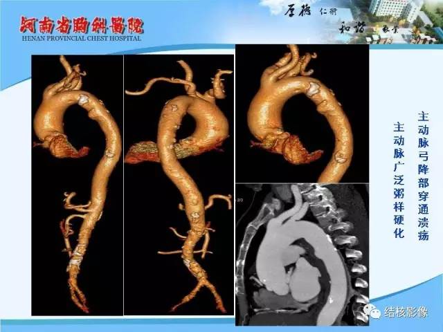 【PPT】胸痛相关疾病的影像诊断