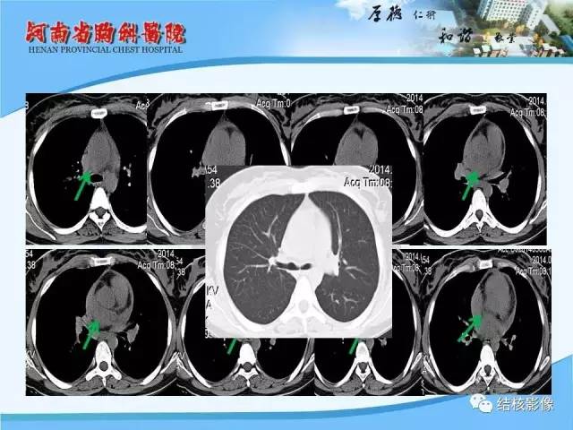 【PPT】胸痛相关疾病的影像诊断