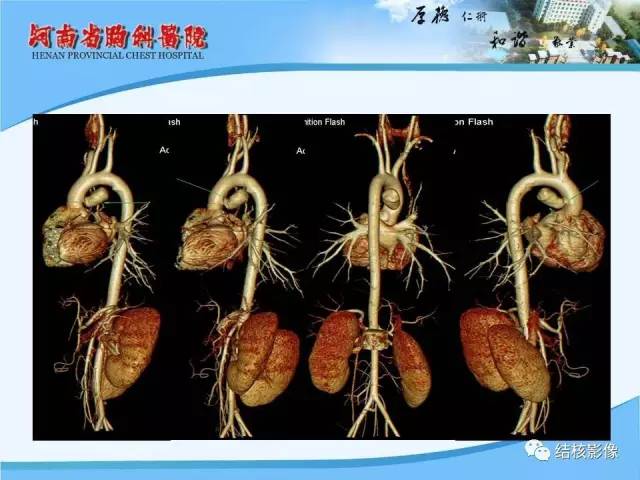 【PPT】胸痛相关疾病的影像诊断