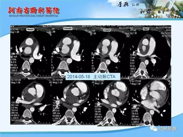 【PPT】胸痛相关疾病的影像诊断