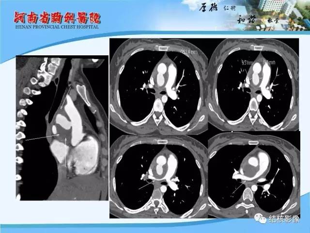 【PPT】胸痛相关疾病的影像诊断