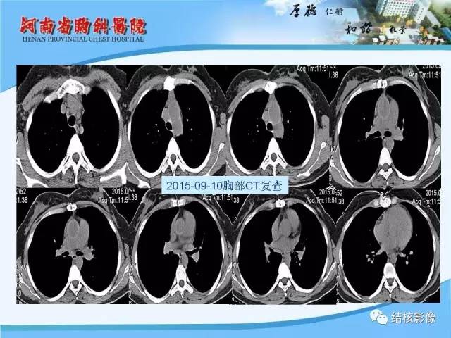 【PPT】胸痛相关疾病的影像诊断