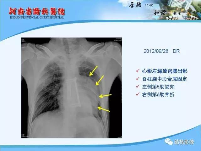 【PPT】胸痛相关疾病的影像诊断