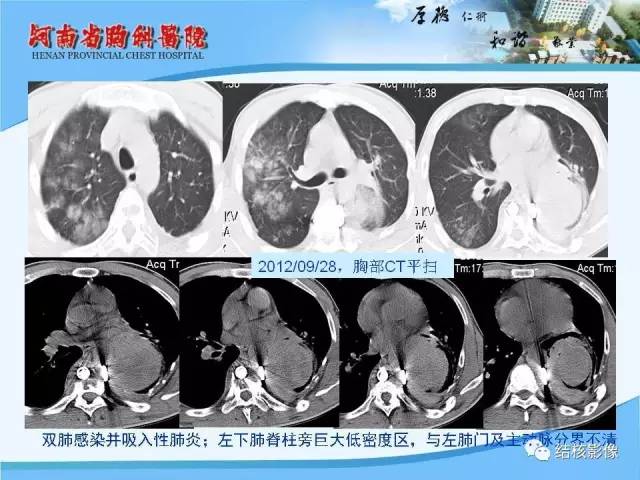【PPT】胸痛相关疾病的影像诊断