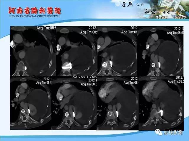 【PPT】胸痛相关疾病的影像诊断