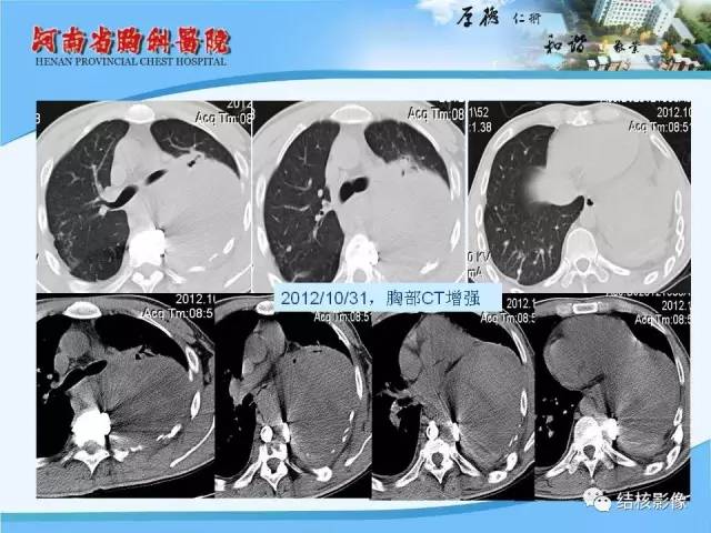 【PPT】胸痛相关疾病的影像诊断