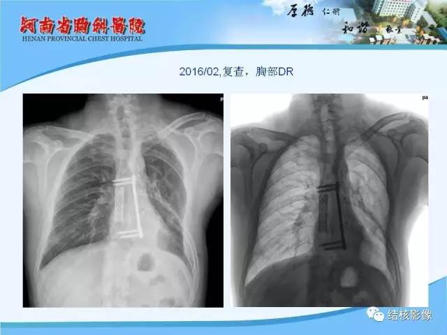 【PPT】胸痛相关疾病的影像诊断