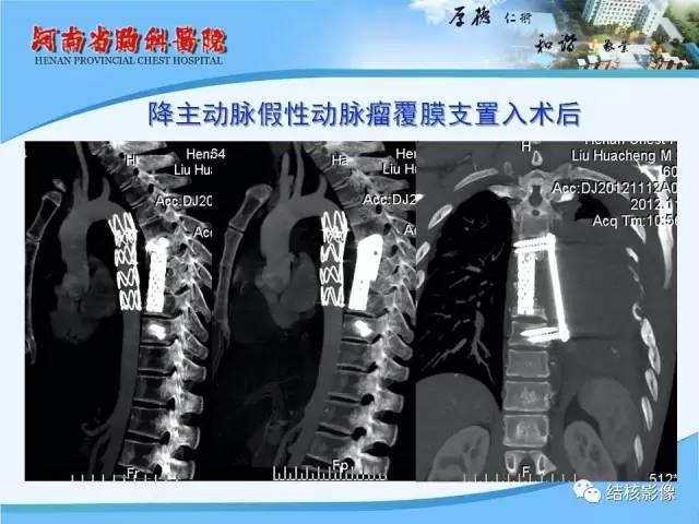 【PPT】胸痛相关疾病的影像诊断