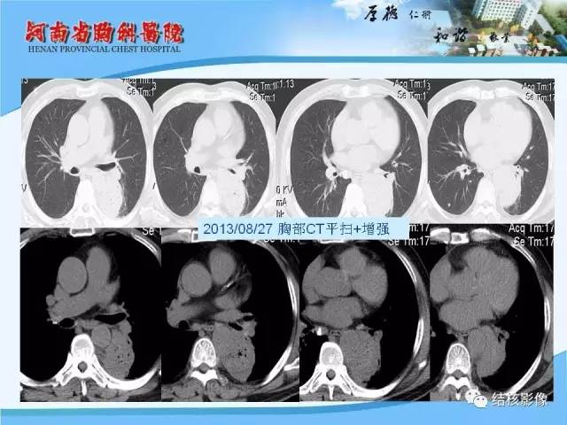 【PPT】胸痛相关疾病的影像诊断