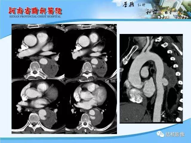 【PPT】胸痛相关疾病的影像诊断