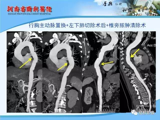 【PPT】胸痛相关疾病的影像诊断