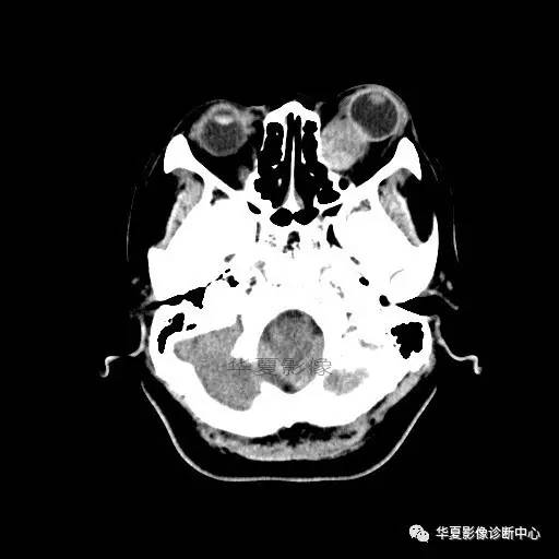 【病例】眶内海绵状血管瘤2例CT和MRI表现