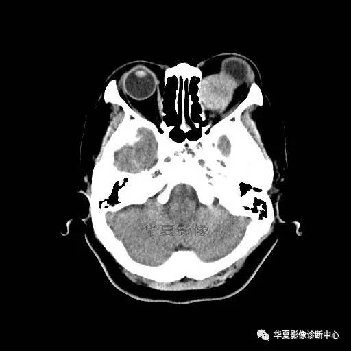 【病例】眶内海绵状血管瘤2例CT和MRI表现 【病例】眶内海绵状血管瘤2例CT和MRI表现