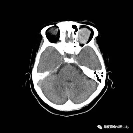【病例】眶内海绵状血管瘤2例CT和MRI表现 【病例】眶内海绵状血管瘤2例CT和MRI表现