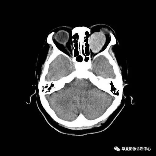 【病例】眶内海绵状血管瘤2例CT和MRI表现 【病例】眶内海绵状血管瘤2例CT和MRI表现