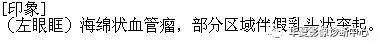 【病例】眶内海绵状血管瘤2例CT和MRI表现