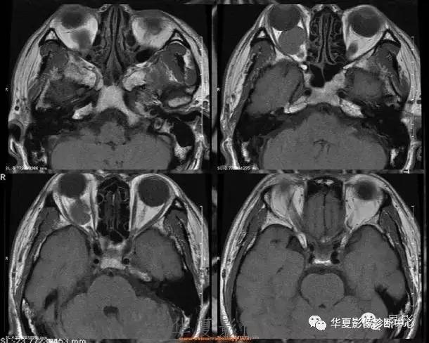 【病例】眶内海绵状血管瘤2例CT和MRI表现 【病例】眶内海绵状血管瘤2例CT和MRI表现