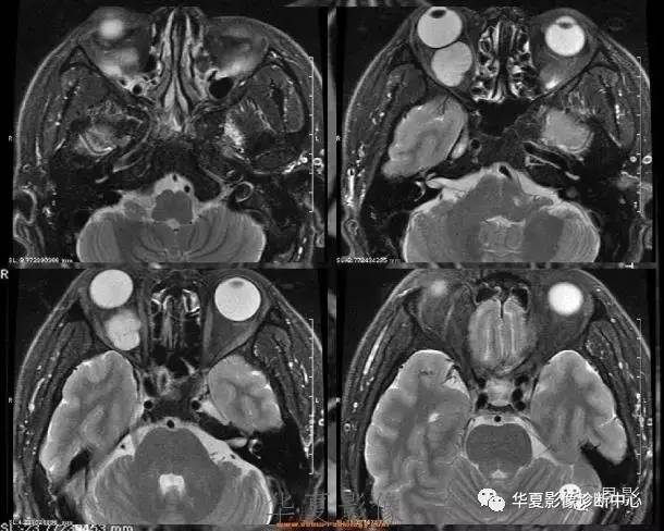 【病例】眶内海绵状血管瘤2例CT和MRI表现 【病例】眶内海绵状血管瘤2例CT和MRI表现