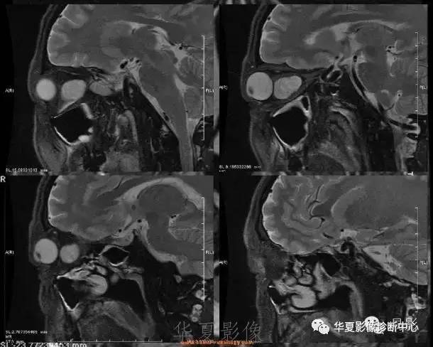 【病例】眶内海绵状血管瘤2例CT和MRI表现 【病例】眶内海绵状血管瘤2例CT和MRI表现