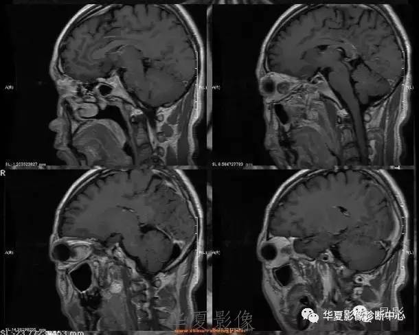 【病例】眶内海绵状血管瘤2例CT和MRI表现 【病例】眶内海绵状血管瘤2例CT和MRI表现