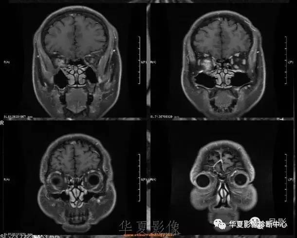 【病例】眶内海绵状血管瘤2例CT和MRI表现 【病例】眶内海绵状血管瘤2例CT和MRI表现