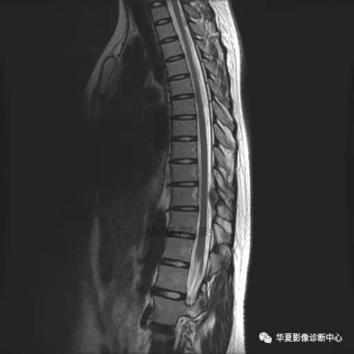 【病例】椎体的骨样骨瘤你见过吗? 【病例】椎体的骨样骨瘤你见过吗?