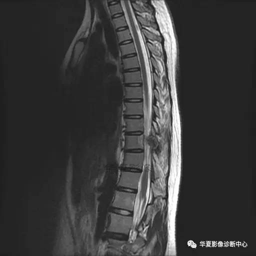 【病例】椎体的骨样骨瘤你见过吗? 【病例】椎体的骨样骨瘤你见过吗?