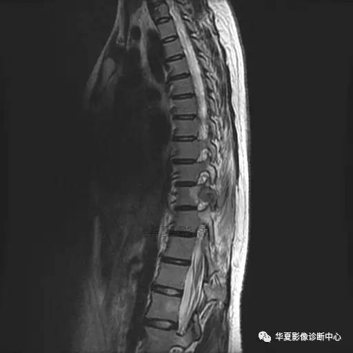【病例】椎体的骨样骨瘤你见过吗? 【病例】椎体的骨样骨瘤你见过吗?