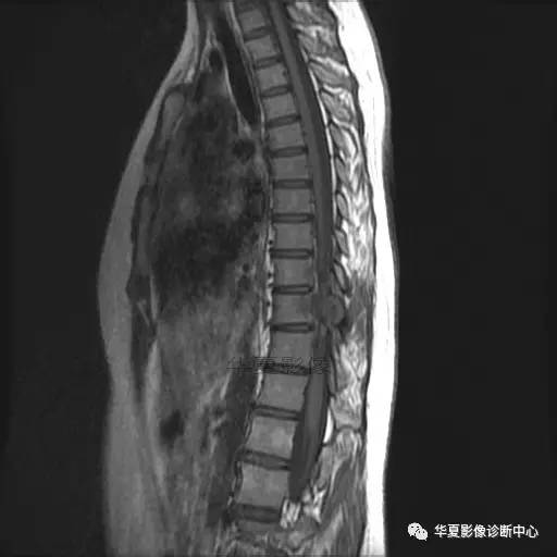 【病例】椎体的骨样骨瘤你见过吗? 【病例】椎体的骨样骨瘤你见过吗?
