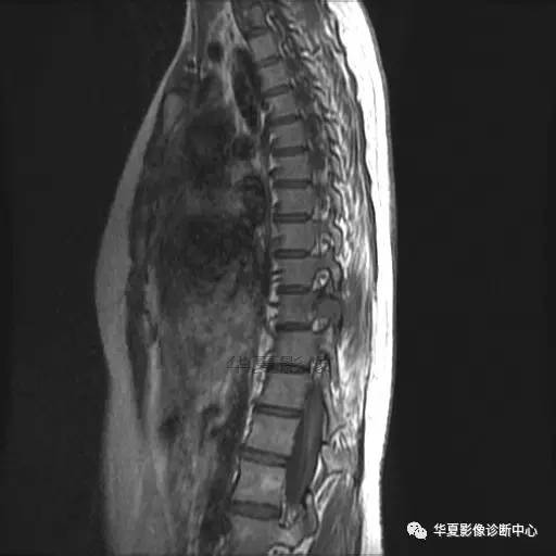 【病例】椎体的骨样骨瘤你见过吗? 【病例】椎体的骨样骨瘤你见过吗?