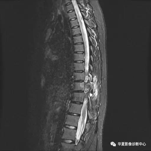 【病例】椎体的骨样骨瘤你见过吗? 【病例】椎体的骨样骨瘤你见过吗?
