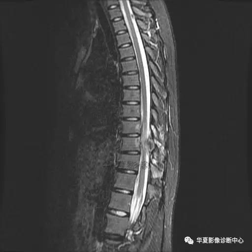 【病例】椎体的骨样骨瘤你见过吗? 【病例】椎体的骨样骨瘤你见过吗?