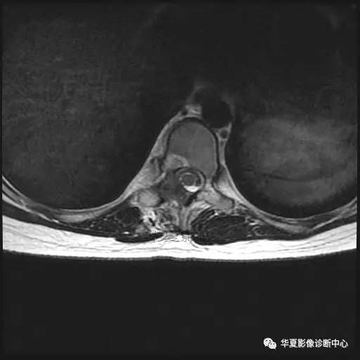 【病例】椎体的骨样骨瘤你见过吗? 【病例】椎体的骨样骨瘤你见过吗?