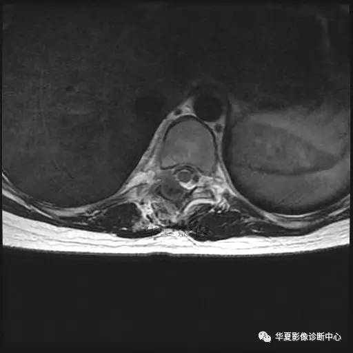 【病例】椎体的骨样骨瘤你见过吗? 【病例】椎体的骨样骨瘤你见过吗?
