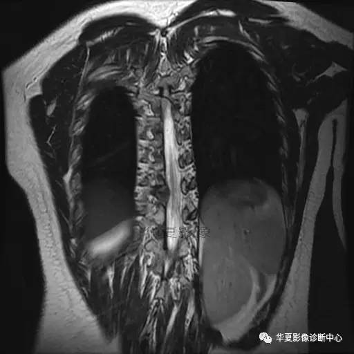 【病例】椎体的骨样骨瘤你见过吗? 【病例】椎体的骨样骨瘤你见过吗?