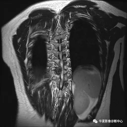 【病例】椎体的骨样骨瘤你见过吗? 【病例】椎体的骨样骨瘤你见过吗?