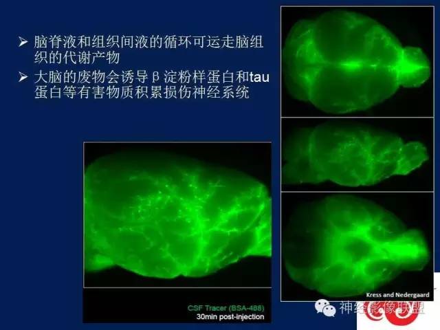 【PPT】脑脊液循环障碍