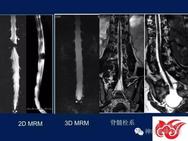 【PPT】脑脊液循环障碍