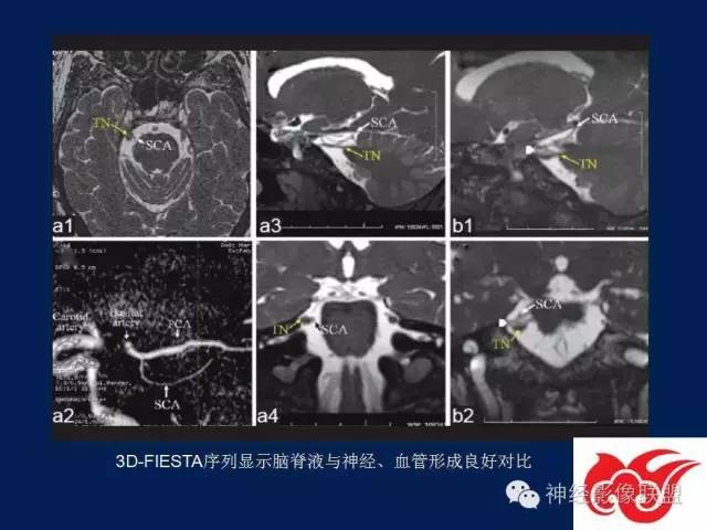 【PPT】脑脊液循环障碍