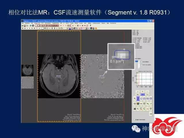 【PPT】脑脊液循环障碍