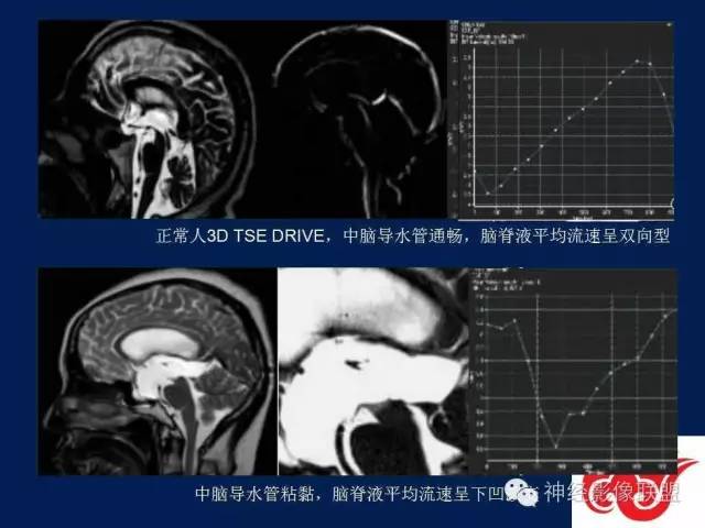 【PPT】脑脊液循环障碍