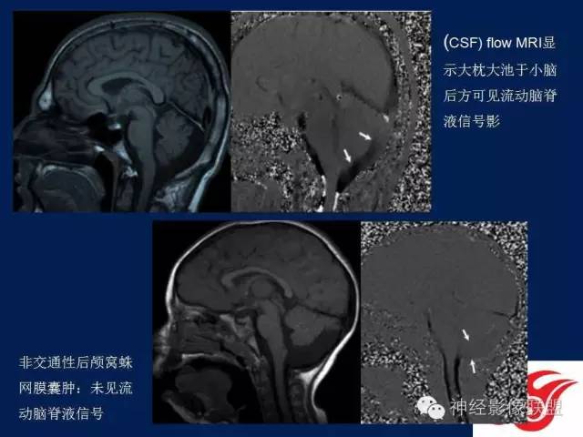 【PPT】脑脊液循环障碍